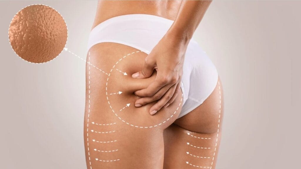 Cellulite