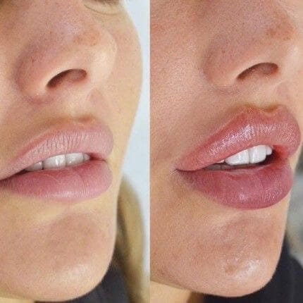 Russian lip augmentation