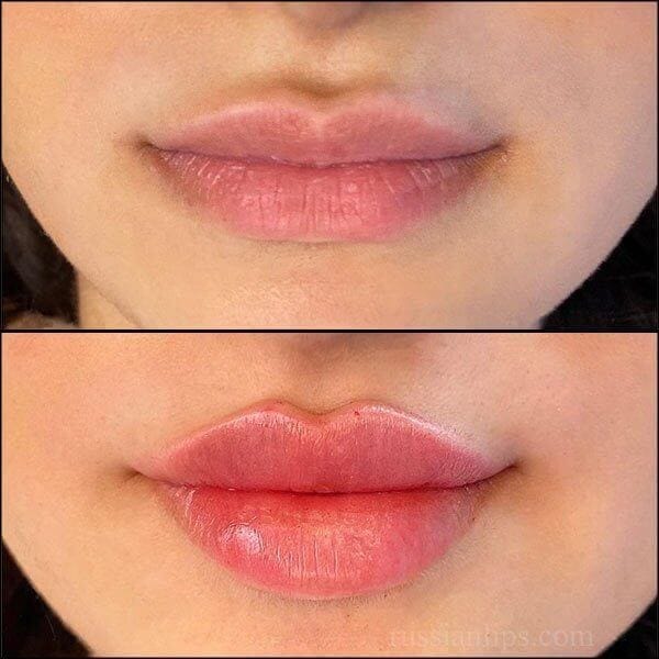 Russian lip augmentation