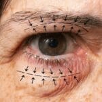 eyelid swelling