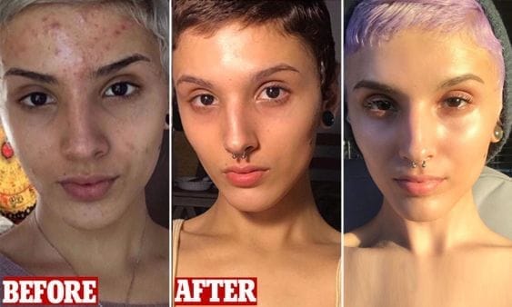 retinol