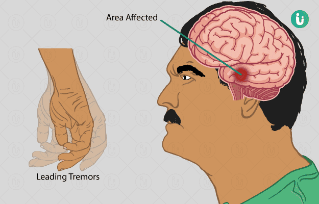 Hand Tremors