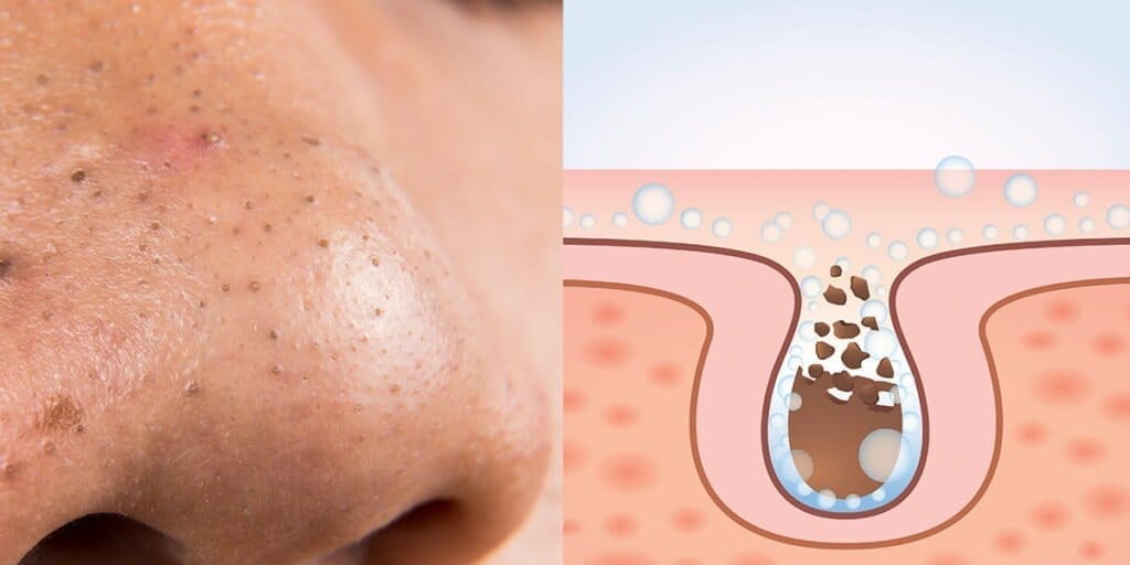 blackheads on the nose